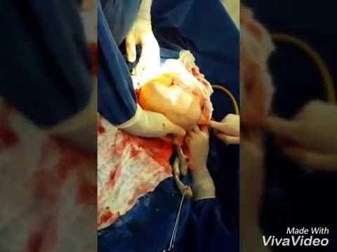 شاهد ولادة طفل إسبانى داخل الكيس الأمنيوسي