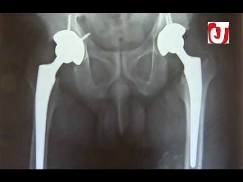 سيدة تستعيد قدرتها على المشي