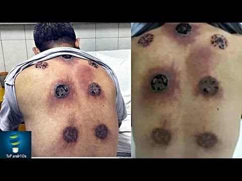 شاهد أغرب العلاجات البديلة