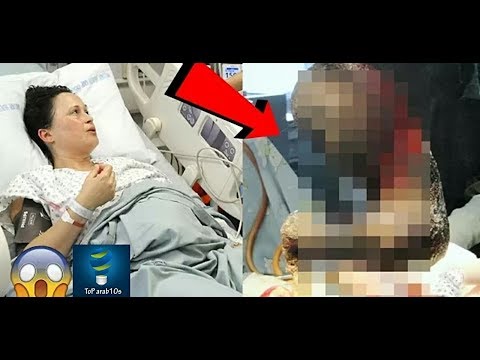 شاهد انقاذ امرأة من انتفاخ خطير في البطن