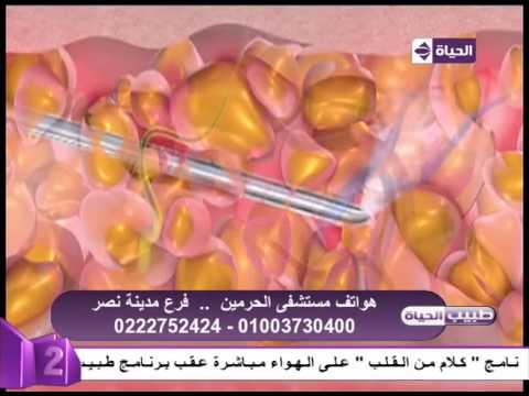 شاهد فيديو يوضح كيفية شفط الدهون على قناة الحياة 2