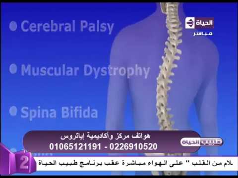 شاهد لقطات لجراحة الانحناء الجانبي للعمود الفقري لدى الأشخاص