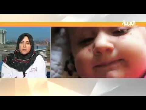 شاهد الجدري فيروس معدٍ يصيب الأطفال بشكل خاص