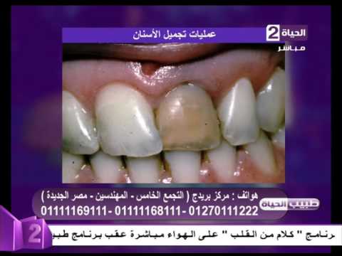 حالات تحتاج إلى تجميل الأسنان