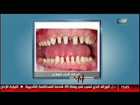 تعرف على أغرب عمليات التجميل لتحسين ابتسامتك