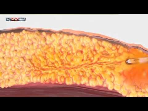 شاهد تقنية جديدة لشفط الدهون بالليزر
