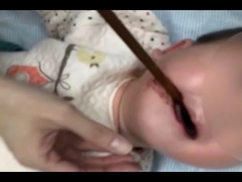 شاهد إنقاذ حياة طفل صيني بعدما اخترقت عصا فمه