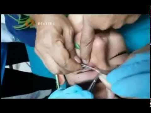 بالفيديو طبيبة تتمكن من استخراج دودة من عين مراهق