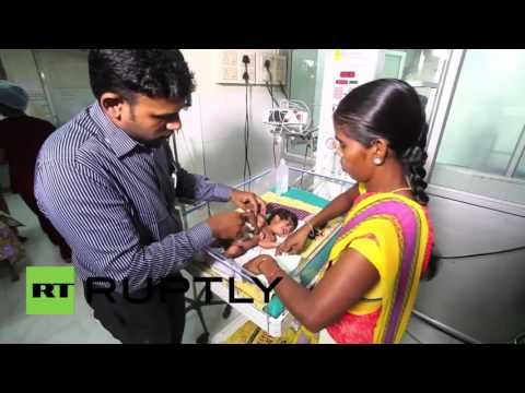 ولادة توأم طفيلي من دون رأس وصدر في الهند