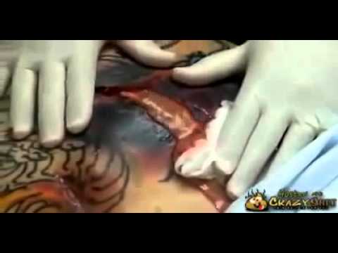 وشم يسبب التهابًا في ظهر امرأة